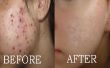 How To Clear Acne Marks | Donkere littekens | Puistje vlekken, Get schoon gezicht huid