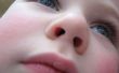 Verwijdering van object geplakt in kind neus vacuüm